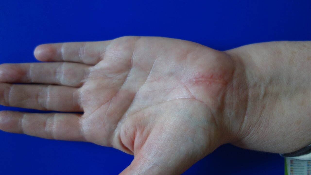 sharp skausmas alkūnės ranką artritas crunched pirštai