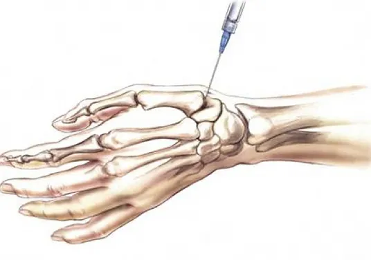 artrozė artritas pėdų gydymas sąnarių dešinės rankos