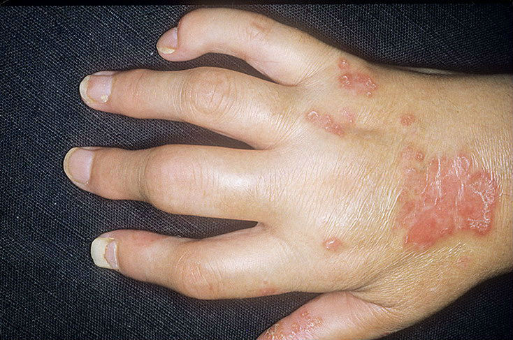 skausmas venų ir sąnarių ranka šepečiai skausmas peties sąnario kairės rankos sukelia gydymas