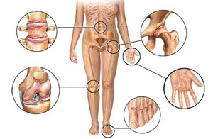 stotelė bendra artrozė artritas
