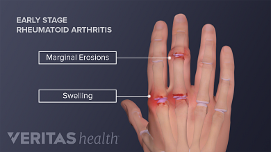 swelling in joints of one hand artrozė peties išlaikyti po traumos