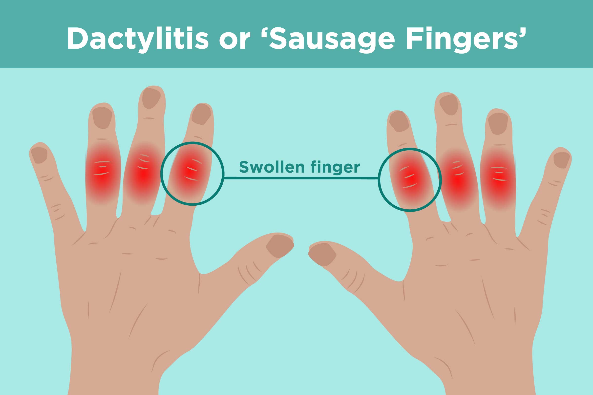 swelling in joints of one hand iš kurių yra sąnarių skausmas