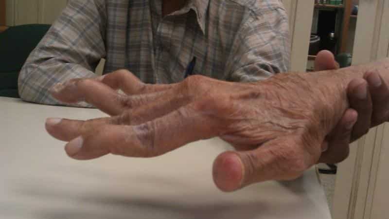 tradicinių gydymo metodai artrito jungčių ką gydo pirštų sąnarius