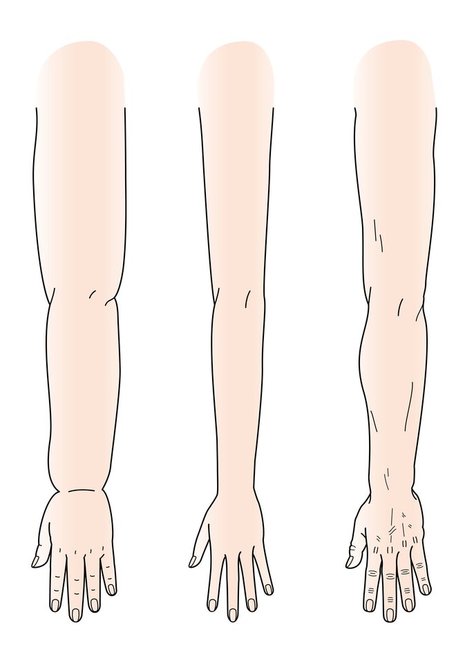 trombai kojose simptomai skausmas raumenyse krizės sąnarių