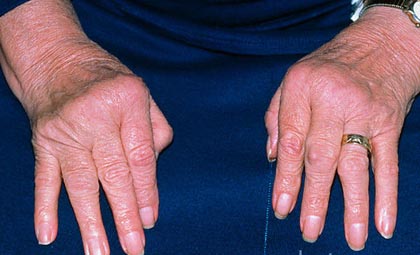 uždegimas sąnarių artritu osteochondrozė gydymas bendrų nuomonių