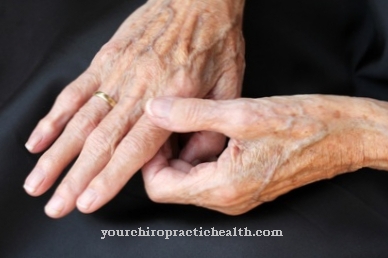 artritas patinimas pirštais artrozė rengen sąnarių