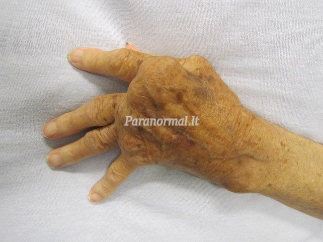 laikykite sąnarius rankomis gydymas arthrisa arthr