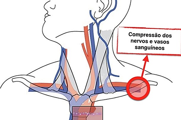 krūtinės angos sindromas simptomai gelis nuo skausmo