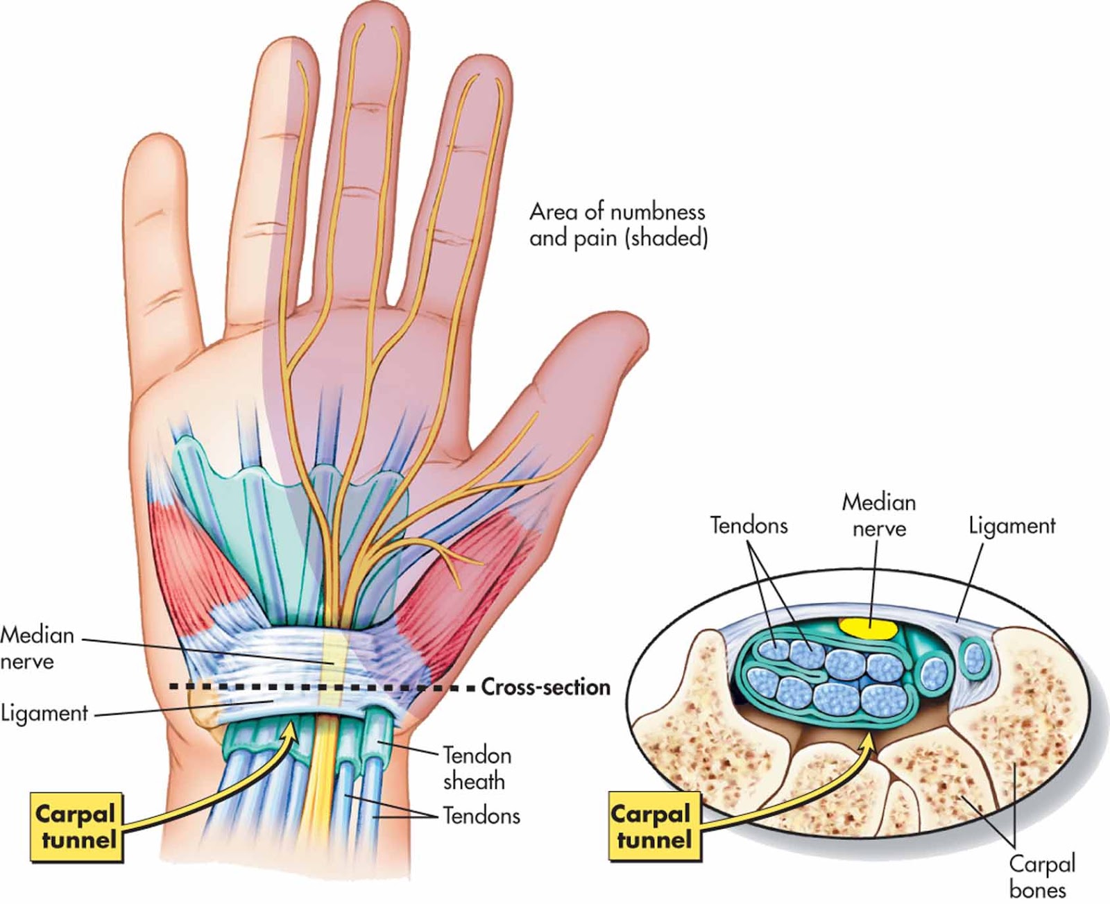 riešo raiščių plyšimas rampa-m per peties sąnario artrozės