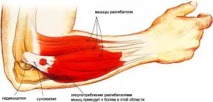 artritas rankas ir kojas
