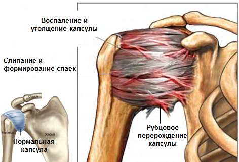 kas yra pavojinga artrozė iš peties sąnario