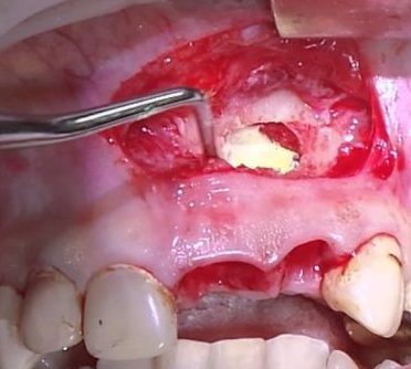 gliukozamino ir chondroitino dantų