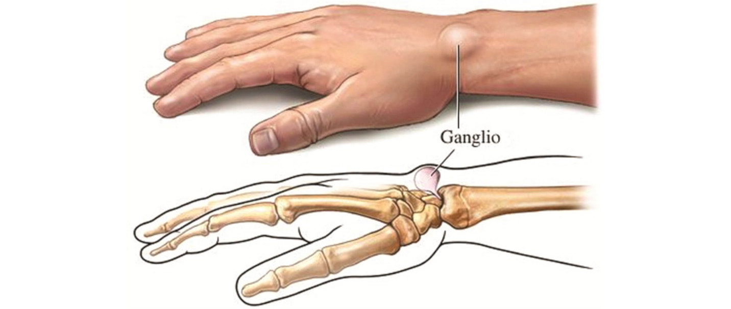 skausmas riešo sąnarius rankas rieso kanalo sindromo simptomai