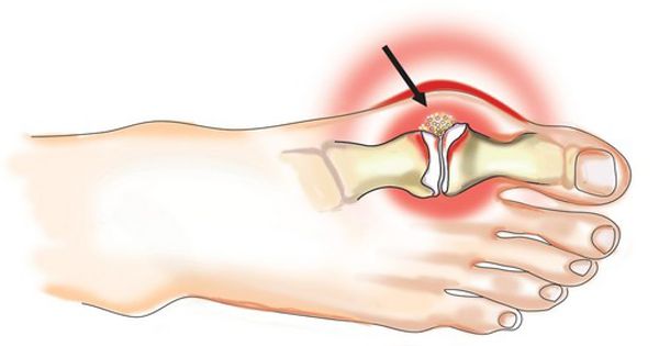 artrozė pėdos sulyginti 1 etapas skausmas peties sąnario kairės rankos po kritimo