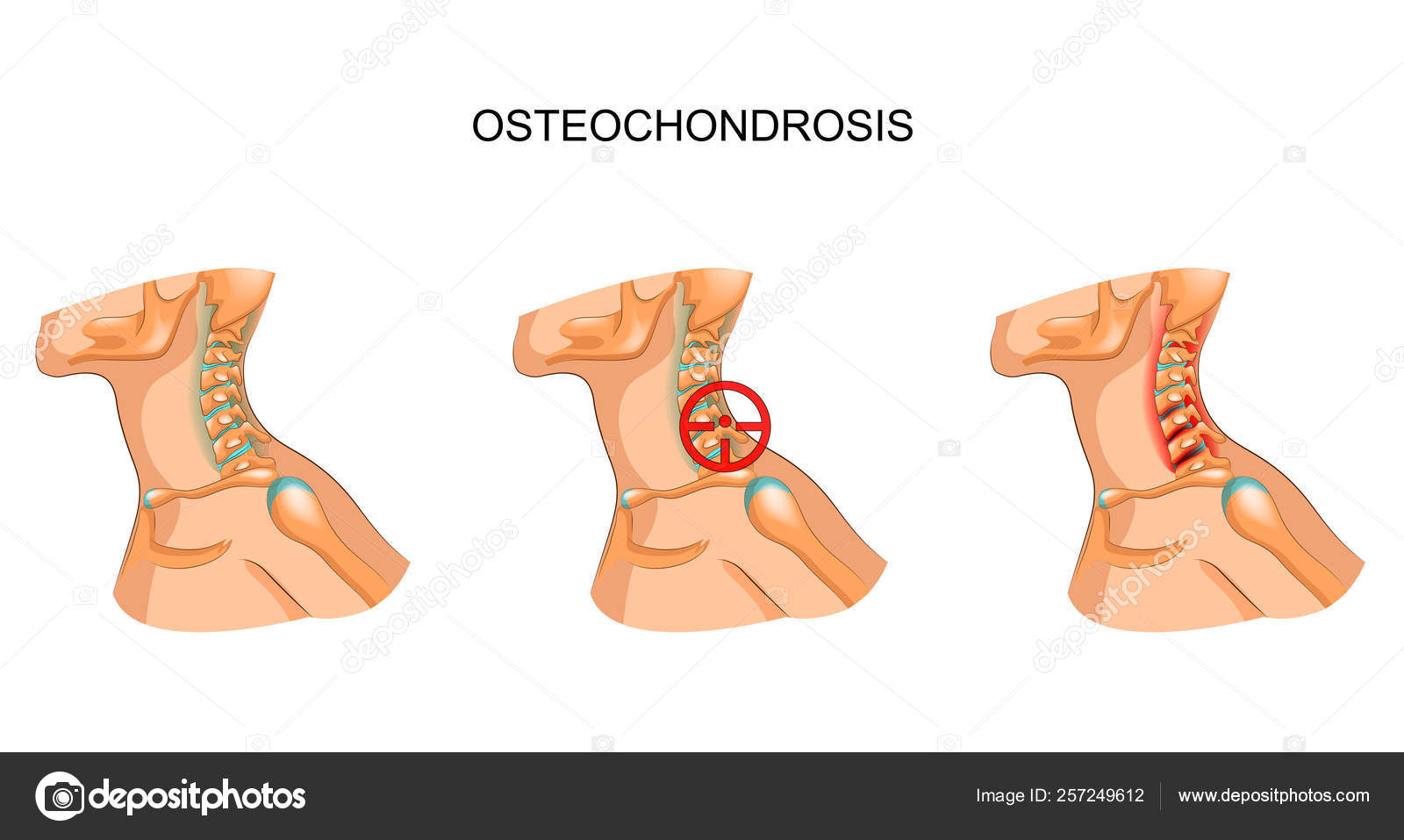 osteochondrozė žasto sąnario blokados