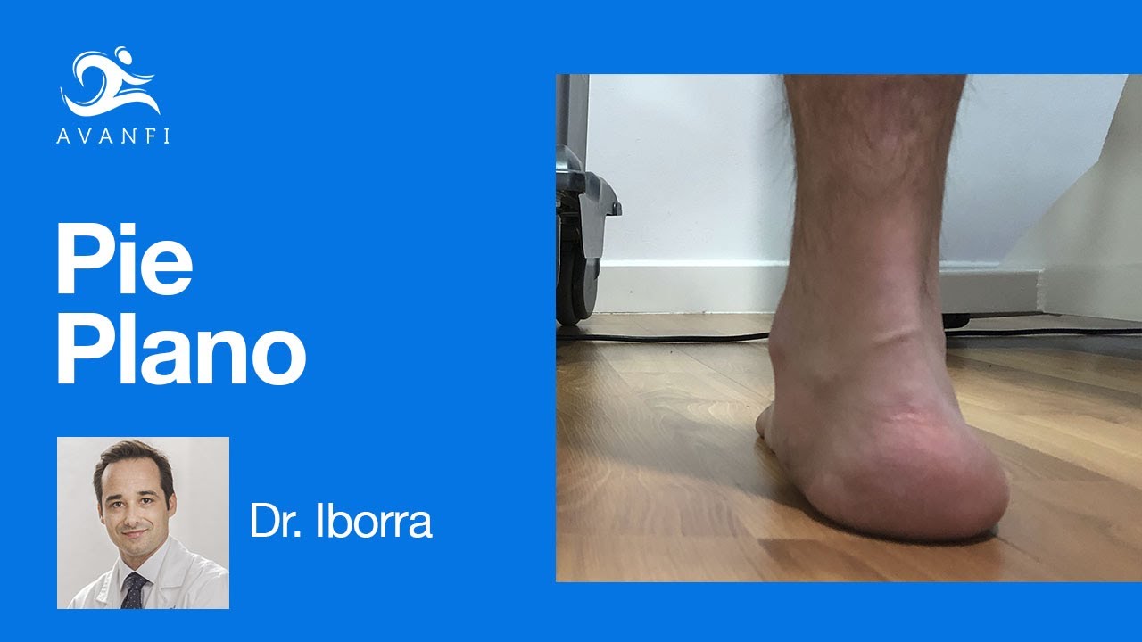artrozė 2 etapais artimuosiuose foot sustav osteoartrito nso