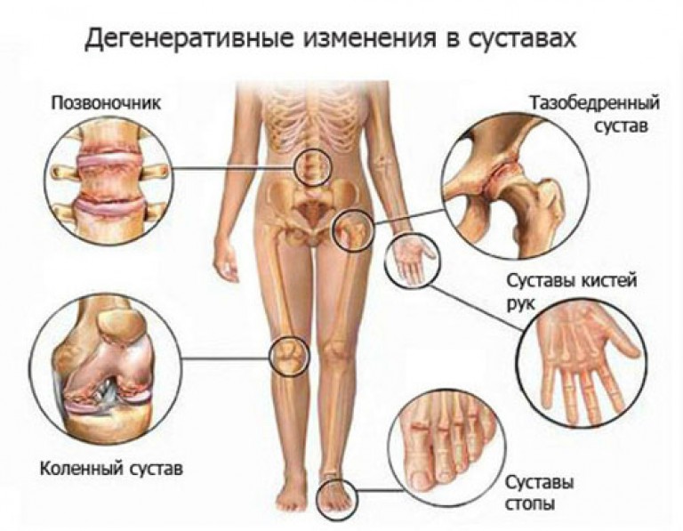 skausmas sąnarių bend artrozė ir artritas rankų