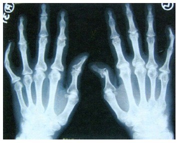 kas yra peties artritas visi sujungimai krizė ligą