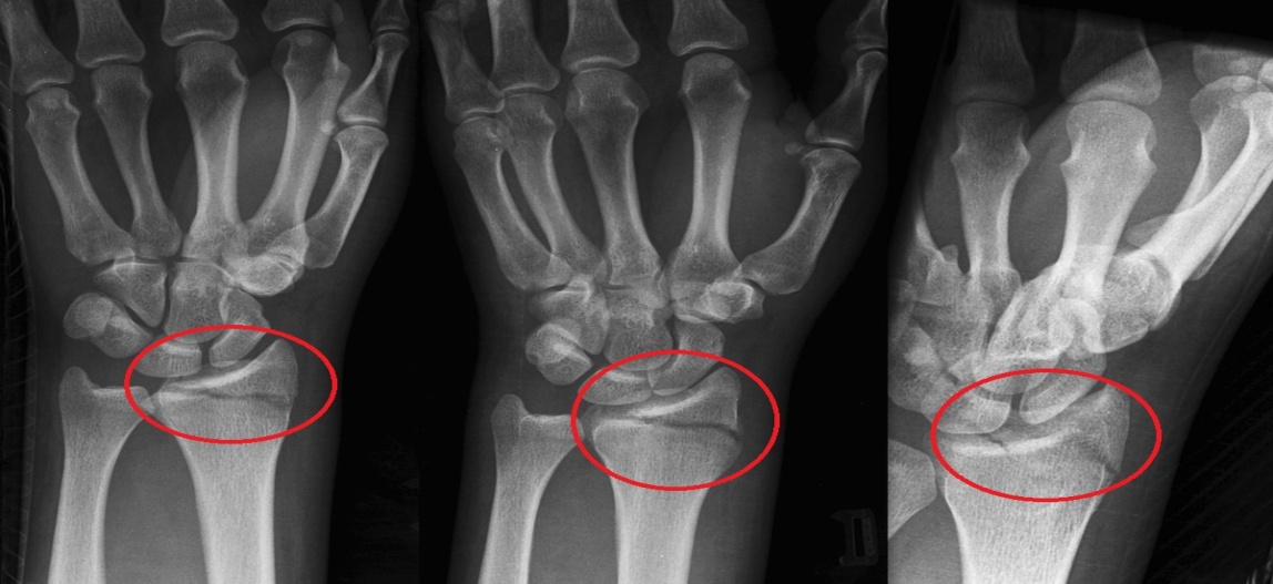 egzema ant artrito rankas kaip įspėti artritas pirštų rankas
