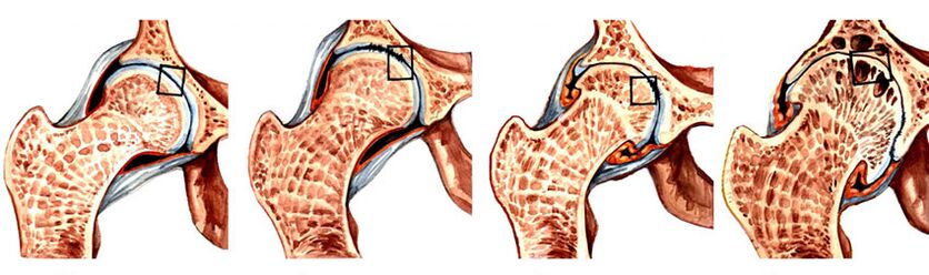 pašildyti tepalas raumenų ir sąnarių edema in facet joints