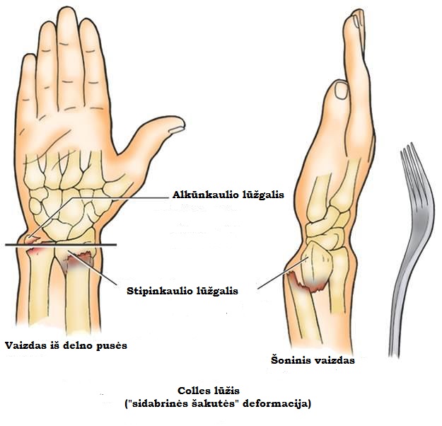 artrozė nykščio ant rankos tepalas ištekėti iš sąnarių