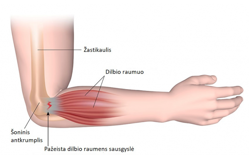 skauda kaires rankos raumenis