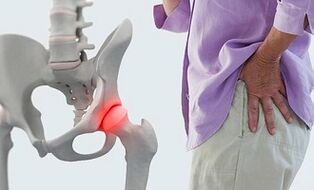 podagra disease rizartroz artritiniu nykščio gydymas