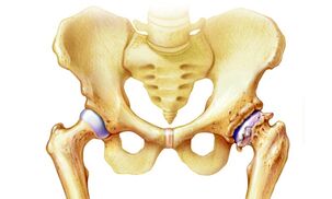 gydymas osteoartrozės pėdos sąnarių gydymas aukso ūsų sąnarių apžvalgos