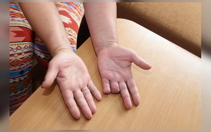 rankų traumos sustav su d_te gydymas gydymas osteoartrito iš piršto sąnarių liaudies gynimo