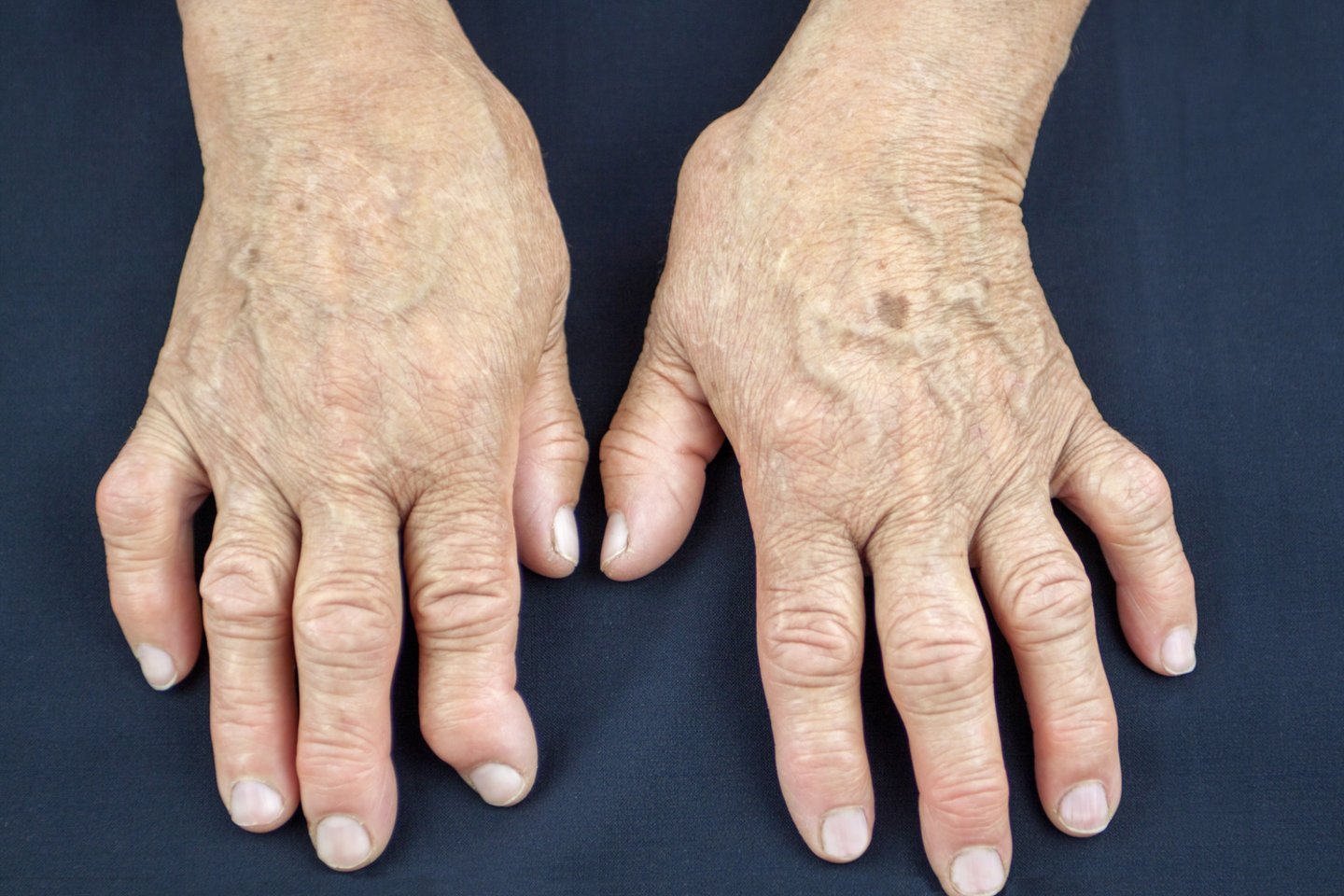 ankstesnis apdorojimo reumatoidinis artritas