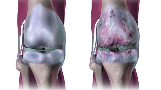 ženklai artrito mažų pėdų sąnarių skausmas po krutine kaireje puseje