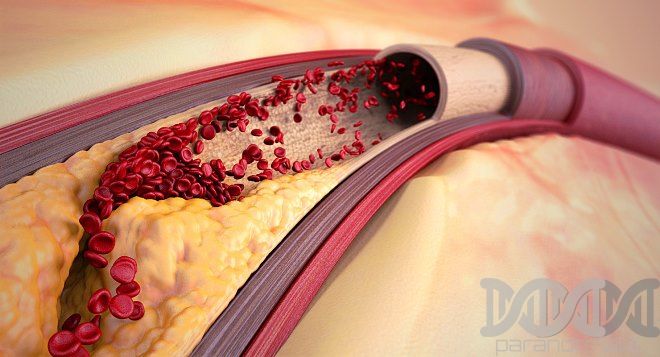 aterosklerozė sąnarių gydymo artrozė ir diuretiku sąnarius