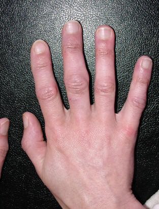 palaikykite rankas artritu šepečiai gydymas arthro sąnarių