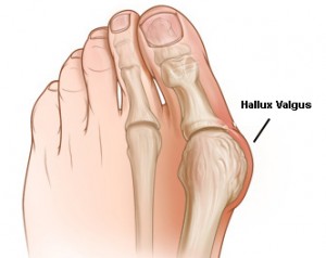 gydymas artrozės ir pėdos nykščio namuose ligos sąnarių