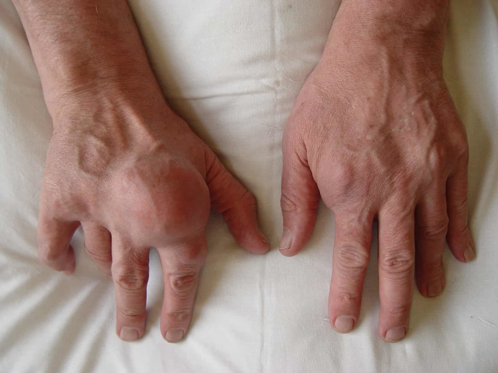 rankų neveikia artritu dėl kokios priežasties sąnariai serga