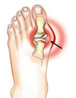 ligos pėdos gydymas sąnarių skauda krutine nestumas