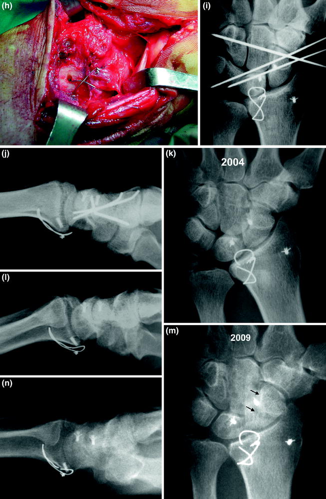 radiocarpal bendra artritas kvarco lempa su ligomis sąnarių