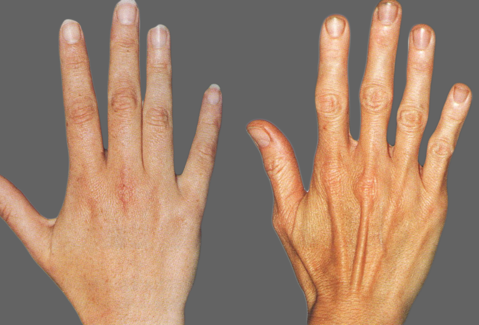 euticoce ir sąnarių skausmas artritas falangie rankų valymo