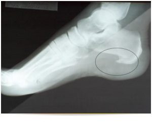 staigus pėdų skausmas artrovex camelia