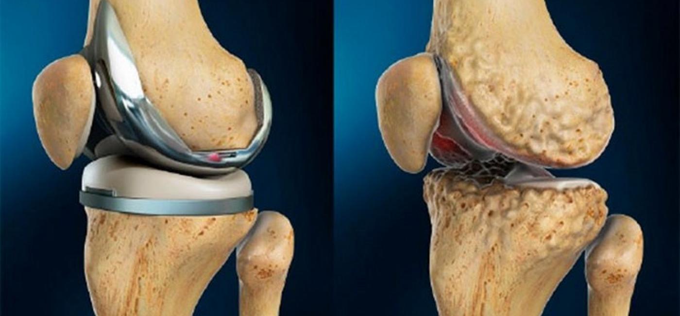 riešo kanalo sindromas operacija kaune skauda nugaros apacia desine puse